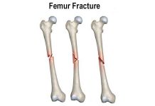 12 Home Remedies to Relieve Femur Fracture