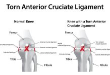 ACL Injury(ACL Tear) – Symptoms and Causes