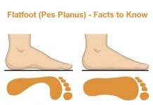Flatfoot (Pes Planus) – Facts to Know