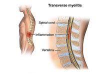 Transverse Myelitis Fact Sheet