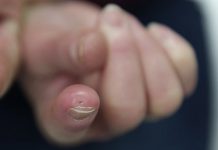 Calcinosis Cutis – Everything You Need to Know