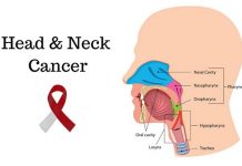 Fungi and Bacteria May Increase Risk of Neck and Head Cancers