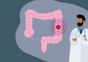 Colorectal Cancer: Risk Factors and Prevention