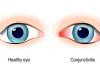 Conjunctivitis – Prevention, Treatment & Diagnose
