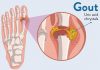 Gout Crystals – Facts You Need to Know