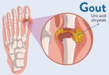Gout Crystals – Facts You Need to Know
