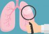 What Is EGFR-positive Lung Cancer and How Is It Treated?