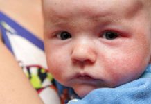 Papular Eczema: Symptoms, Causes, and Treatment