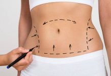 Tumescent Liposuction Benefits, Precautions, Pictures, and More