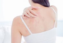 Ways That Can Help You Treat Lichen Planus