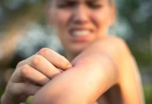 How to Treat Insect & Spider Bites