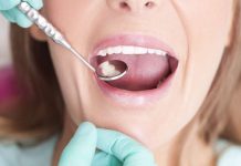 Everything You Need to Know About Composite Fillings