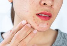 Folliculitis (Barber’s Itch) – Symptoms, Causes, Treatment & More