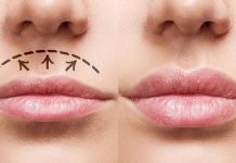 Bullhorn Lip Lift: What You Need to Know