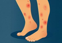 How Erythema Nodosum Is Connected to IBD