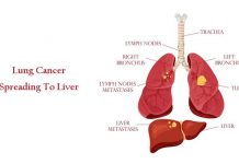 Lung Cancer Spreading To Liver: Prognosis and More