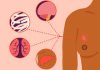 Metastatic Breast Cancer: What Is It, Symptoms, and More