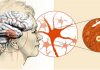 What Is Parkinson’s Plus Syndrome?