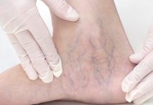 Chronic Venous Insufficiency – Causes, Symptoms, Diagnosis and More