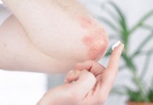 10 Home Remedies for Psoriasis and How to Avoid Triggers